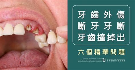 牙齒掉了|牙齒掉落、斷裂怎麼辦？牙醫教保住牙齒關鍵處置｜元 